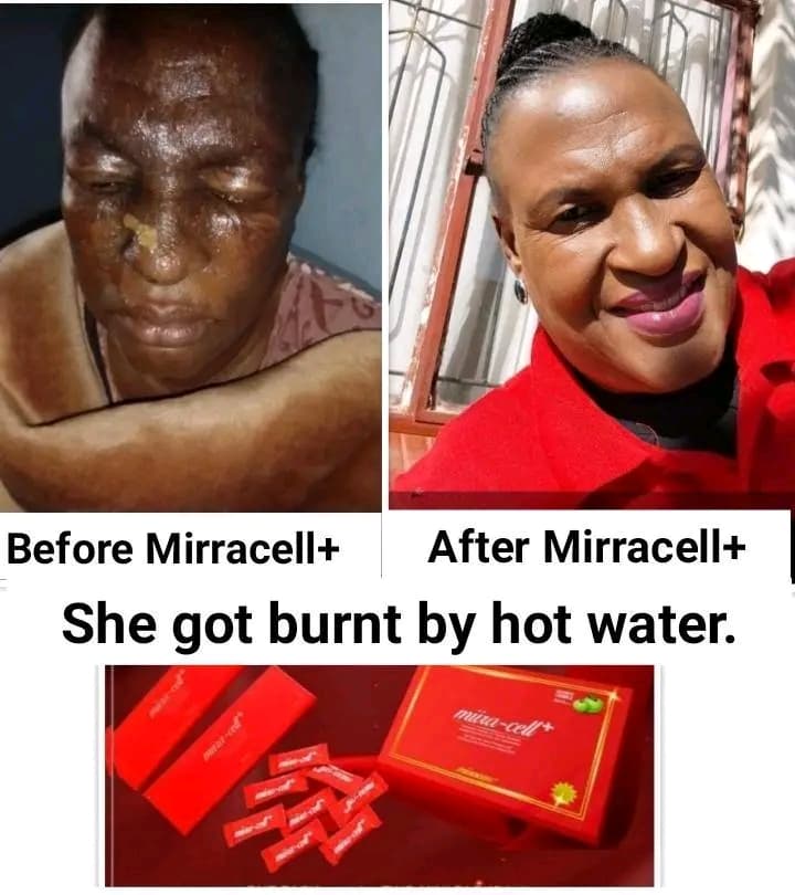 Burn Scar Recovery