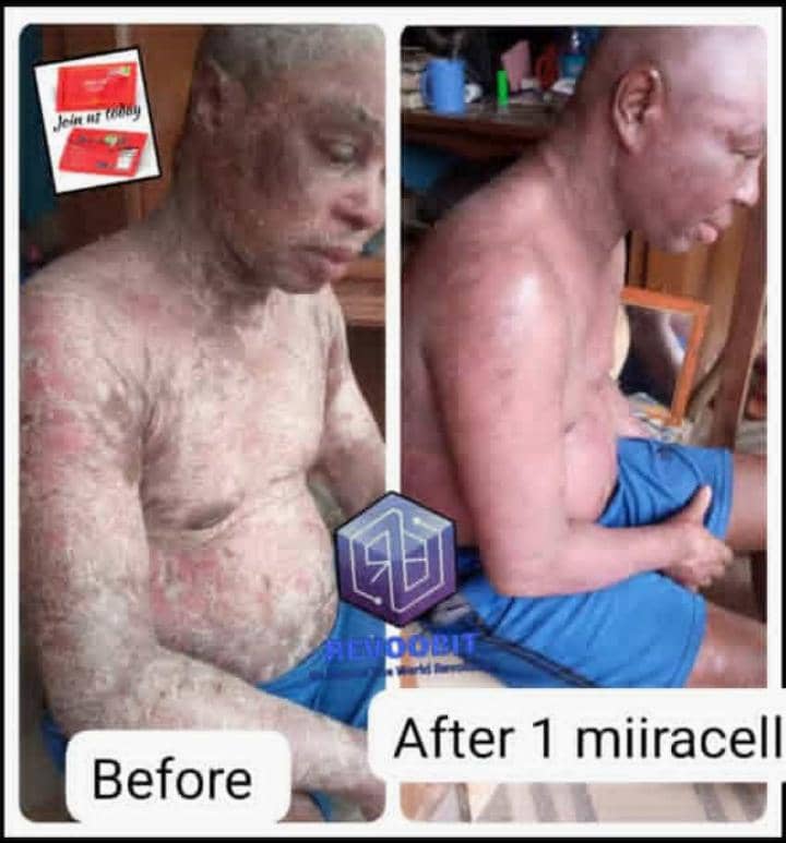 Skin Disease Recovery