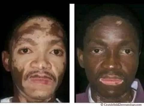 Facial White Scar Healing