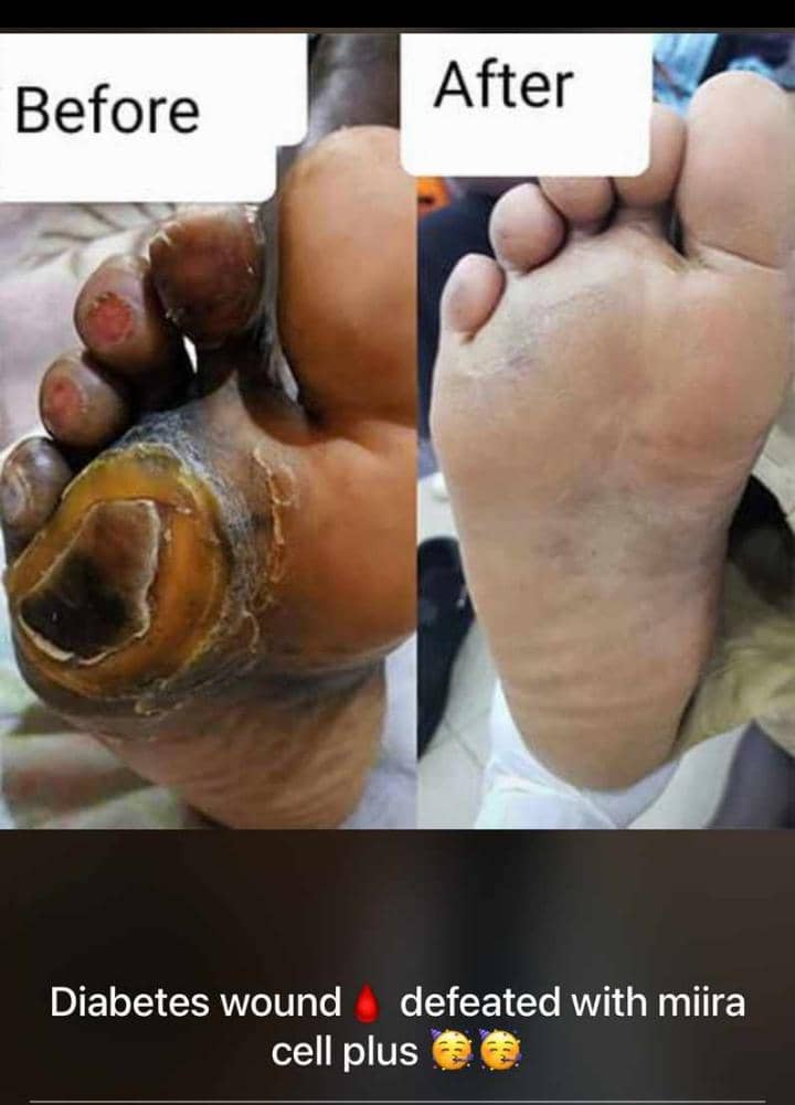 Diabetic Ulcer Healing
