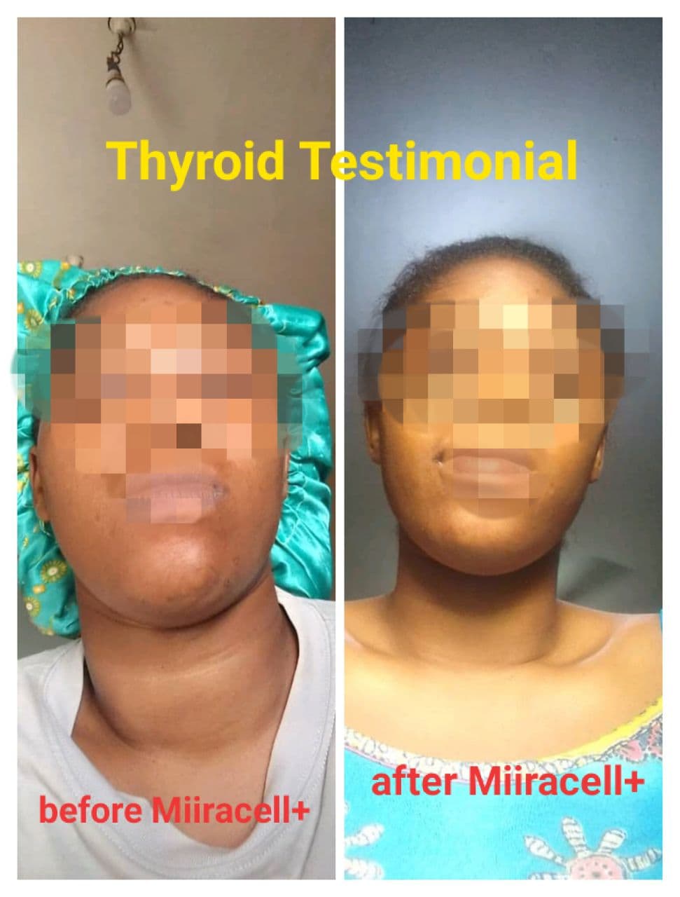 Thyroid Neck Recovery